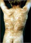 mosaicism_small mosaicism_small